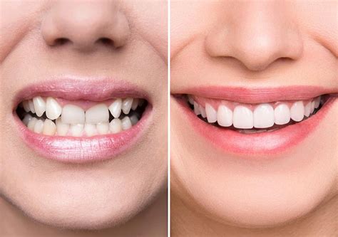 In stage one, metal brackets are fastened to the patient's teeth and then connected with a metal wire to straighten and align teeth.once your teeth are straight. How To Fix A Crooked Smile Naturally