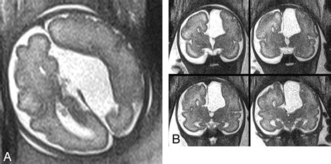 A Prospective Study Of Fetuses With Isolated Ventriculomegaly
