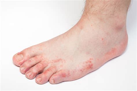 Tinea Pedis Athletes Foot Symptom Causes Medication And Prevention