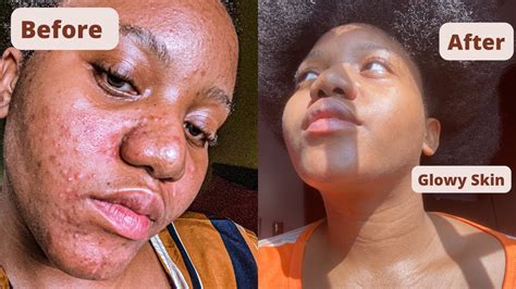 How I Cleared My Acne And Hyperpigmentation How I Got Rid Of Textured