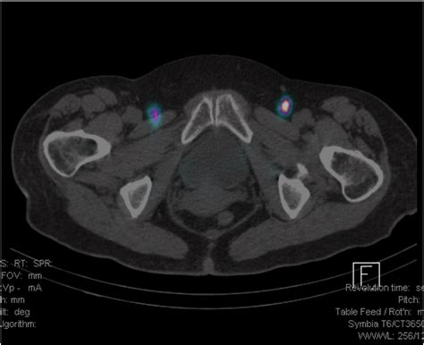 Update On Sentinel Lymph Node Biopsy For Early Stage Vulvar Cancer