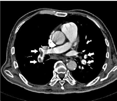 Axial Ct Image Shows Emboli In Both The Lower Lobar Segmental Pulmonary