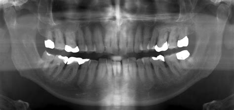 True gum disease is actually called once you have periodontal disease, you have to go to your regular dental cleaning visits. Replacement of missing mandibular incisors following bone ...