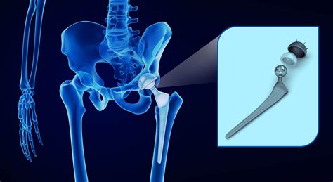 Joint Replacement Texas Orthopaedic And Sports Medicine
