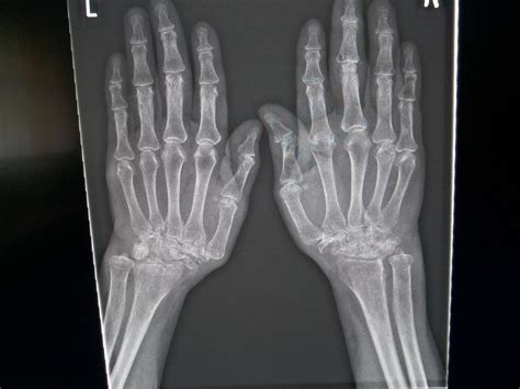 Rheumatologe Rheumatoid Arthritis Radiographic Progression