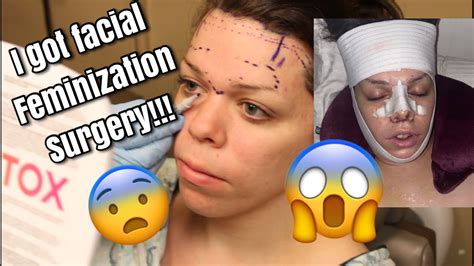 I Got Facial Feminization Surgery PART 1 YouTube