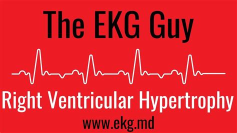 Right Ventricular Hypertrophy On Ekg Ecg L The Ekg Guy Ekg Md