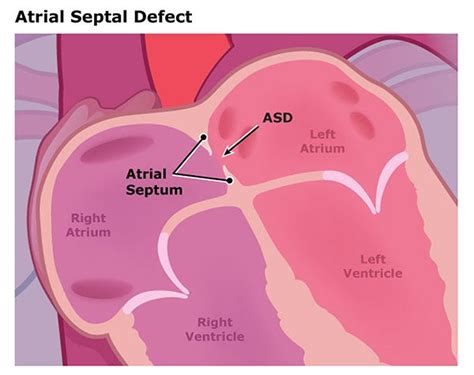 Atrial Septal Defect Anatomy