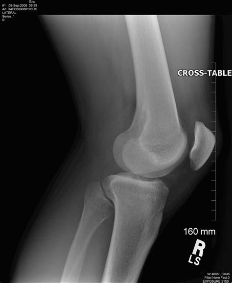 Knee With Patella Right X Ray 0000 No Info Picture Taken Flickr
