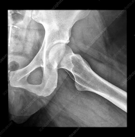hip x ray lateral view