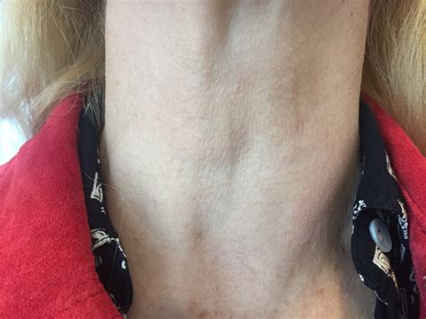 Thyroid Rfa 101 Cosmetic Issues Related To A Big Benign Goiter Nodule