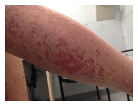 Erythematous Papular Rash