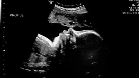 how does an ultrasound produce an image of a fetus in the mother s uterus