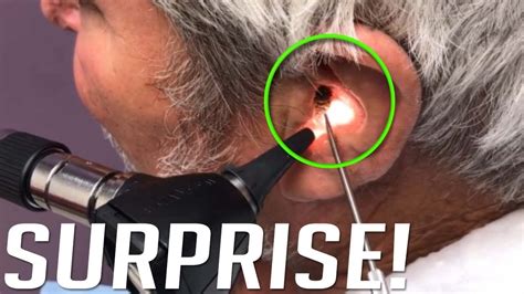 Biggest Ear Wax Removal Ever Youtube