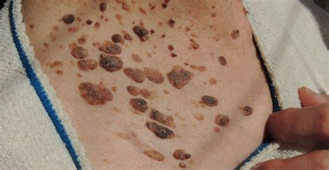 Actinic Keratosis Treatment Lakewood Ca Coastal Dermatology And Plastic