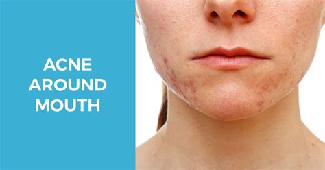 Acne Around The Mouth Causes And Best Treatments Acne Around The