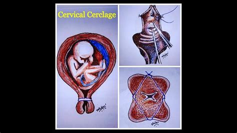 Update 124 Purse String Suture Cervix Latest Vn
