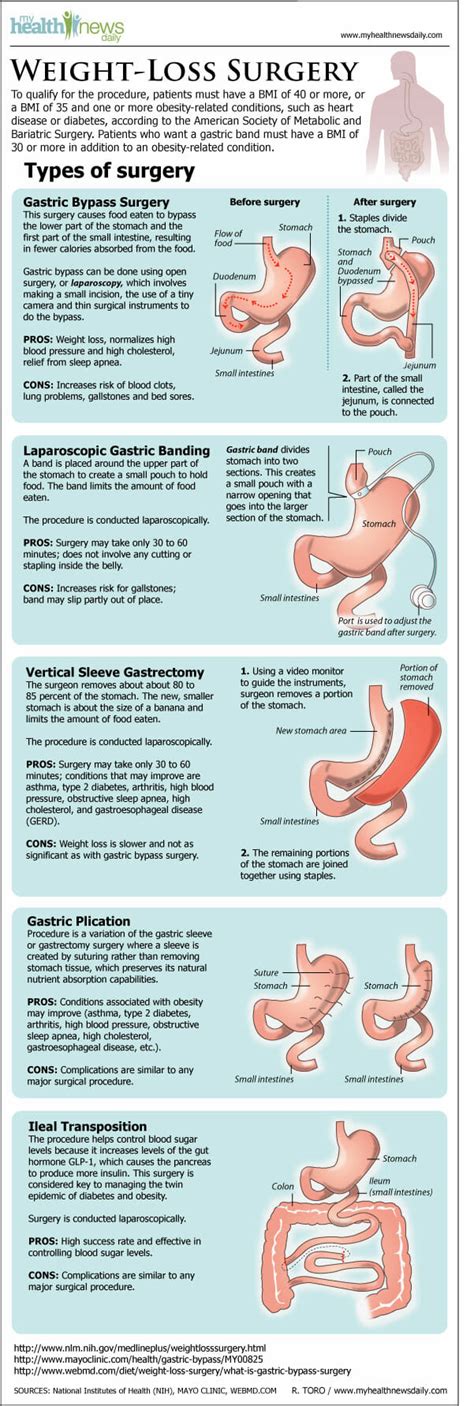 Infographic Types Of Weight Loss Surgery Healthstatus