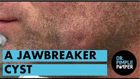 A Jawbreaker Epidermoid Cyst Pimple Popping Videos