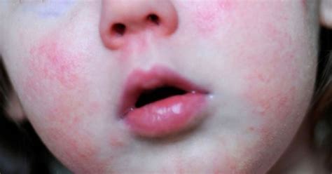 Outbreak Of Scarlet Fever Reported In Part Of Leicestershire