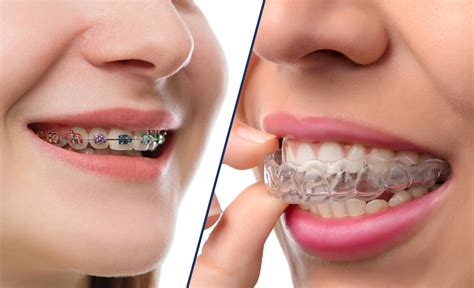 Invisalign vs Braces, The Best Competition all around: - Thorndike ...