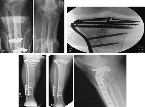 Treatment Of Proximal Tibia Fractures Using The Less Invasiv