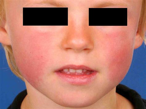 Erythema Infectiosum Practice Essentials Background