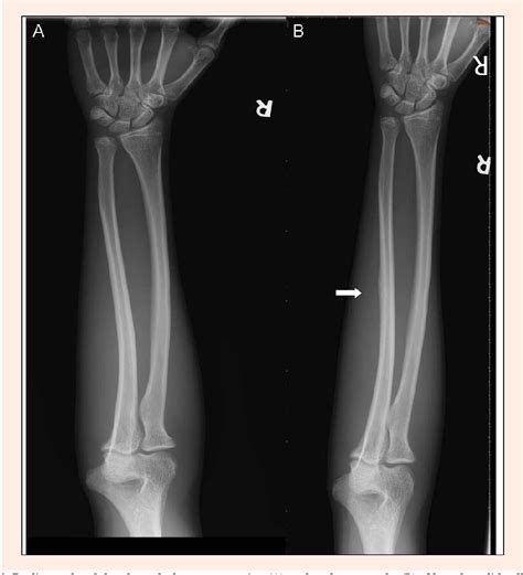 Ulna Hairline Fracture