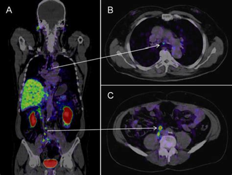 Psma Pet Ct Accurately Detects Prostate Cancer Spread Nci