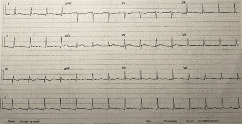 Rare Ecg Finding In A Patient With Severe Hypercalcaemia Bmj Case Reports