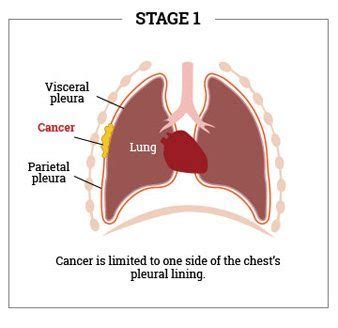 Mesothelioma is a rare cancer caused by asbestos. Malignant Mesothelioma Cancer | Prognosis, Treatment ...