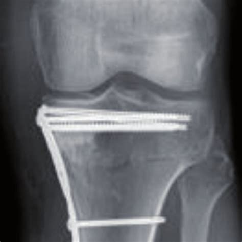 ap radiograph of a medial tibial plateau fracture treated by orif with porn sex picture