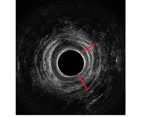 Endoanal Ultrasonography Depicting Intact External Anal Sphincter After