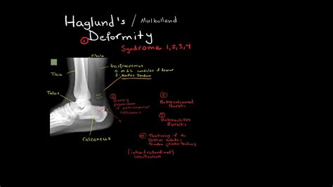 Haglund S Deformity Radiology Youtube