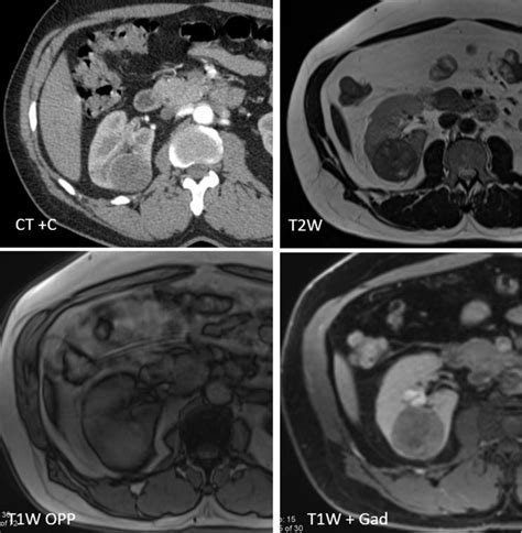 This Incidental Finding On Ct Resembles A Simple Or Minimally Complex