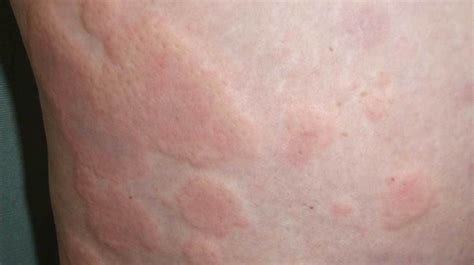 What Is Chronic Idiopathic Urticaria And How Is It Treated