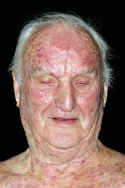 Eczema On The Face Photograph By Dr P Marazziscience Photo Library