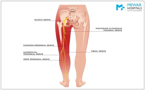 Sciatica Causes Symptoms Treatment And Diagnosis Mewar Hospitals