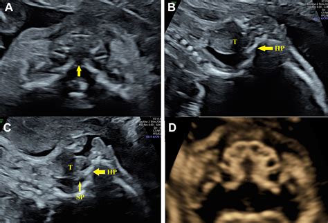 A Pitfall In Prenatal Ultrasonic Detection Of Submucous Cleft Palate