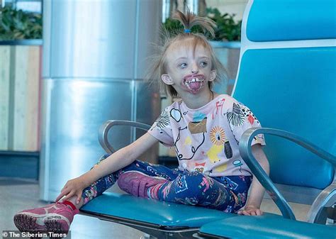 Russian Girl Who Was Born With No Lips Or Chin Flies To London For Surgery To Rebuild Her Face