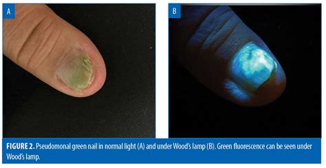Revealing The Unseen A Review Of Wood S Lamp In Dermatology Jcad