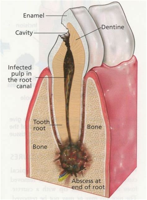 Dentaltown The Anatomy Of A Dental Abscess This Is What Happens When