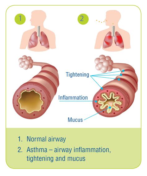 Asthma Lungs Compared To Normal Lungs