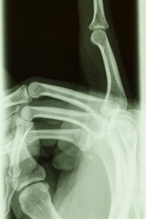 Xray Of Human Hand Stock Image Image Of Healthy Surgery 22335073