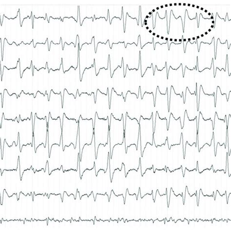 Triphasic Wave In An Electroencephalography Eeg Of Patient With