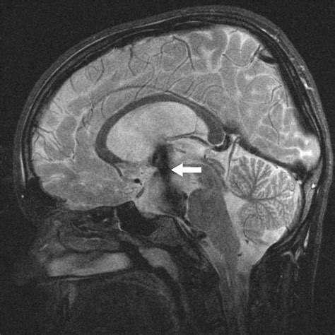 Endoscopic Fenestration Of Suprasellar Arachnoid Cyst Encyclopedia Of