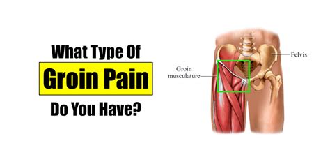 Groin strains are among the most common type of muscle strain, but they can be particularly annoying due to their location. What Kind of Groin Pain Do You Have? - Squat University