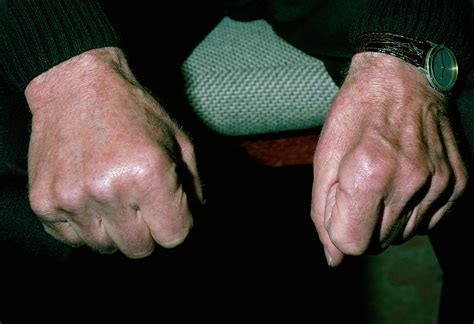 Muscle Wasting In Hand Due To Ulnar Nerve Damage Photograph By Science