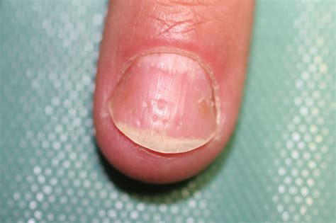 Dedos de la mano en enfermedades reumáticas Dedos de la mano