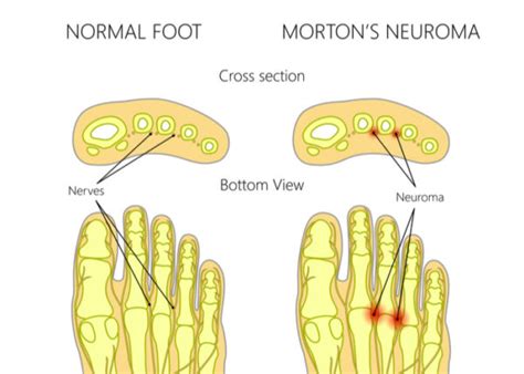 Neuroma Surgery Mortons Neuroma Foot And Ankle Specialist Vail